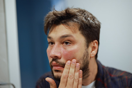 Man looking at a red rash on his cheek in a mirror 
