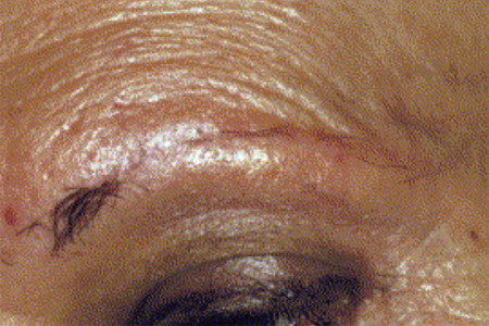 Close-up of eyebrow shows most of it has disappeared