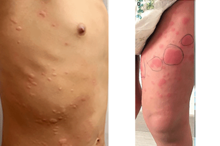 COVID-19 can cause hives (left), Child with hives caused by COVID infection (right)