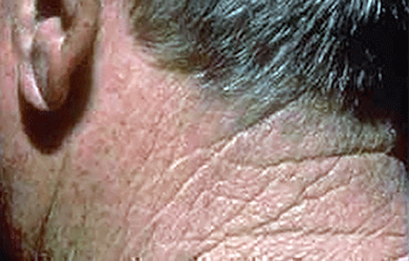 Rough-feeling patch of skin on back of a man's neck is a symptom of actinic keratosis