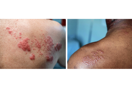 Shingles rash on shoulder of white person and on shoulder of Black person
