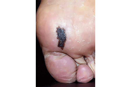 Melanoma on the bottom of a foot