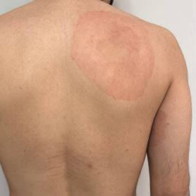 Image of a man's back showing signs of infection by Trichophyton indotineae