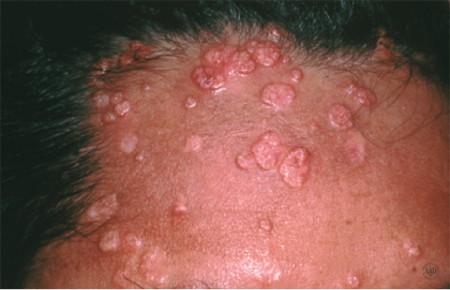 Molluscum contagiosum large bumps on man's forehead