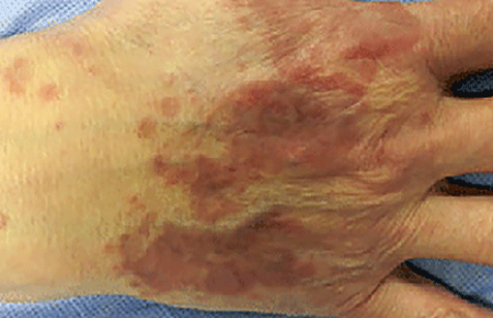 Generalized granuloma annulare on skin