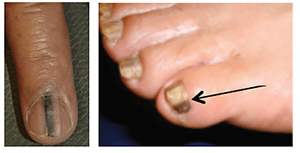 Black Spot Under Toenail Melanoma - Bios Pics