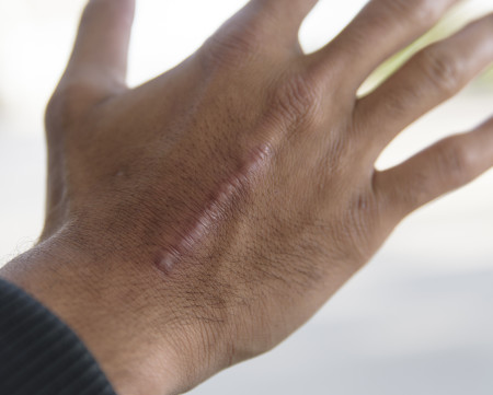 Keloid scar on hand