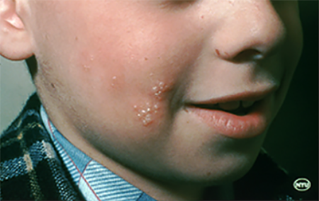 herpes simplex outbreak