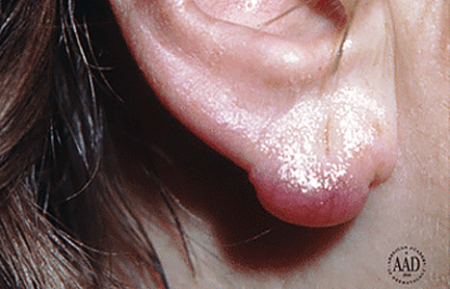 Borrelial lymphocytoma on a child’s ear
