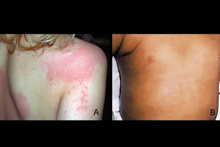 Hives, shown on a lighter skin tone and a darker skin tone, can mean a higher risk of developing atopic dermatitis. 