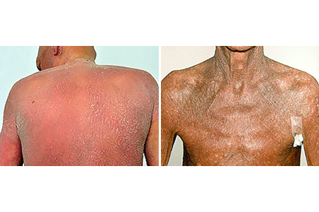 Sézary syndrome can cause a rash on most the skin or leave the skin feeling hot and painful
