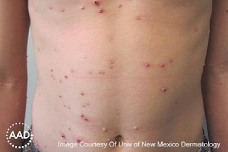 A child with atopic dermatitis has developed a skin infection, which is causing red bumps on his chest and belly.  