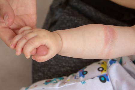 baby holding parent's hand. Eczema on the arm.