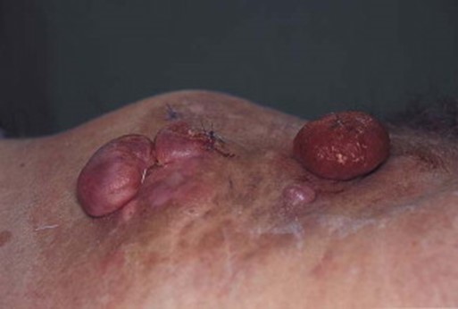 Image of dermatofibrosarcoma protuberans recurrence