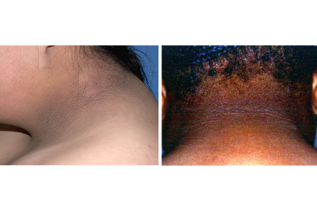 Velvety skin on neck of white person with diabetes compared to dark, velvety skin on neck of Black person can be a sign of prediabetes
