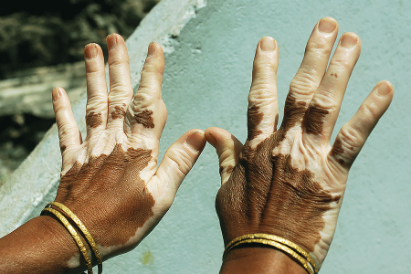 White patches on Black woman’s hands due to vitiligo