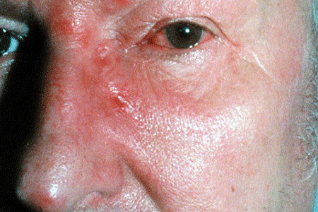 Shingles rash