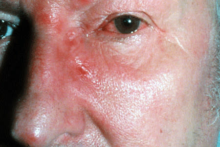 Shingles: Signs and symptoms