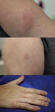 Images for DWII of capillary malformation-arteriovenous malformation syndrome