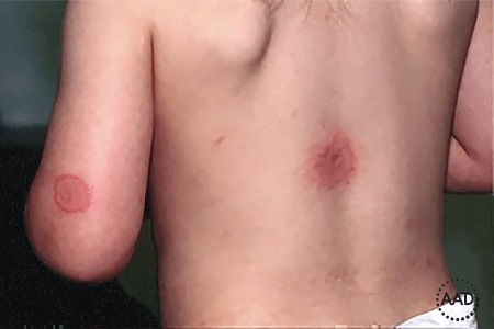 Child’s hives appear after he’s bitten by mosquitos.