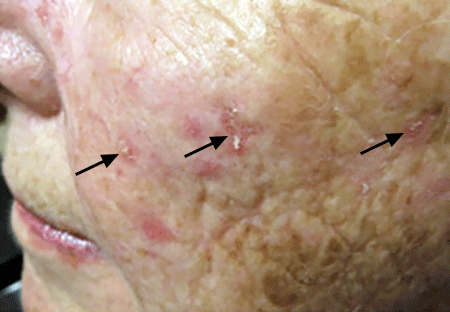 Rough, scaly bumps on this woman's face are actinic keratoses