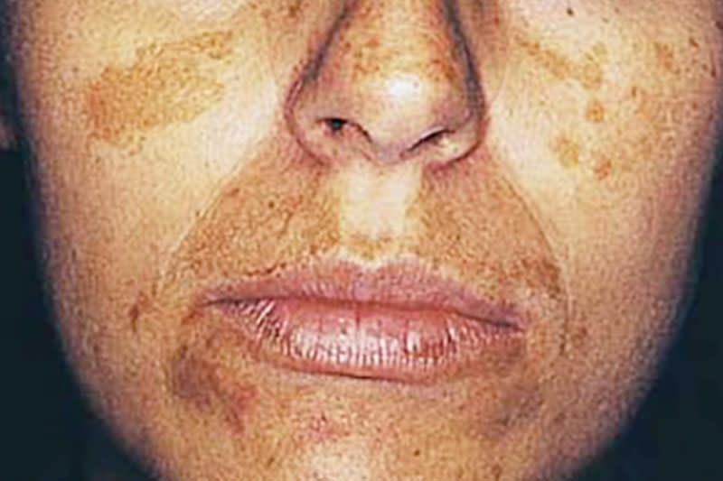 Melasma in darker skin