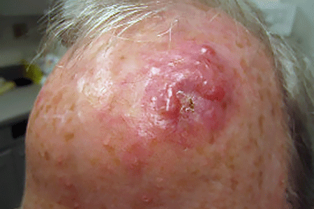 A fast-growing mass on the forehead of this man's head is Merkel cell carcinoma