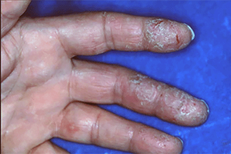 Contact dermatitis caused by massage oil