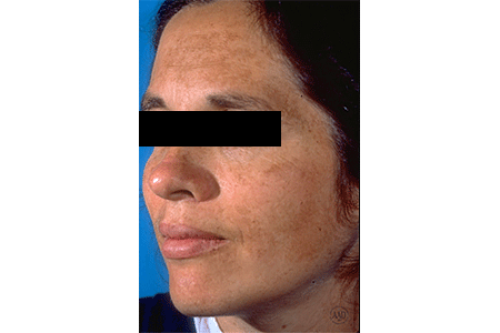 Melasma on women’s forehead and cheeks