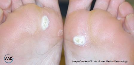 Figure 2. Plantar warts, seen as hyperkeratotic plaques on weight-bearing sites of the soles. Source: AAD.