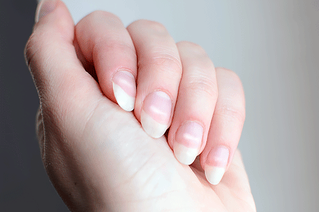 Woman's fingernails with white spots