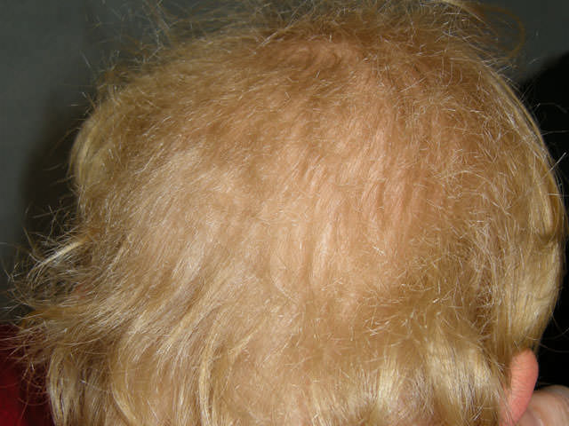 Woolly hair nevus type 2 Rare entity