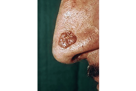 Brown, raised, lumpy, and round basal cell carcinoma on nose