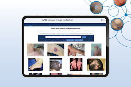 Screen capture from the AAD Clinical Image Collection.