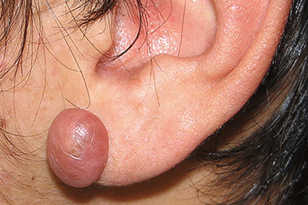 Keloid scar on ear