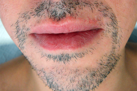 Close-up of patchy beard