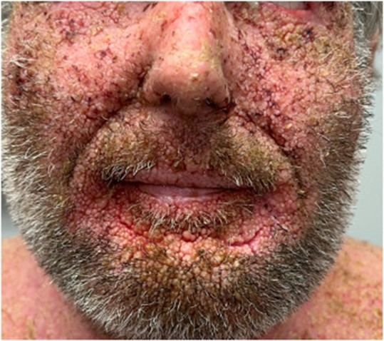 Image for DWII of Darier disease