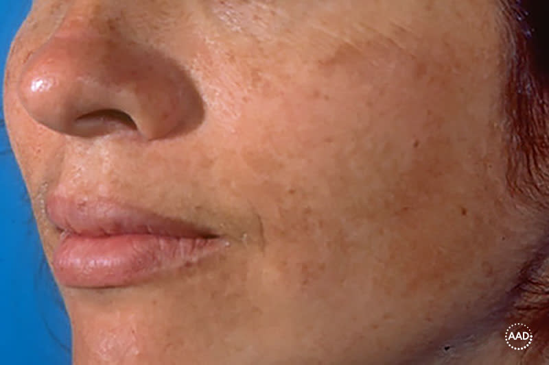 Melasma in lighter skin
