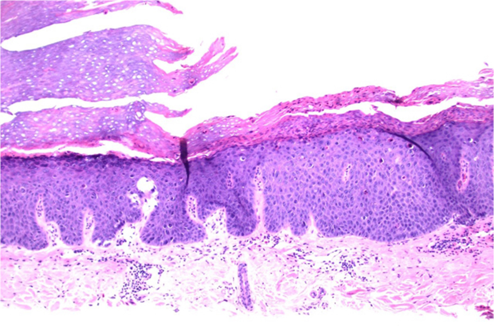 Image for DWII of microscopy of hypokeratosis 
