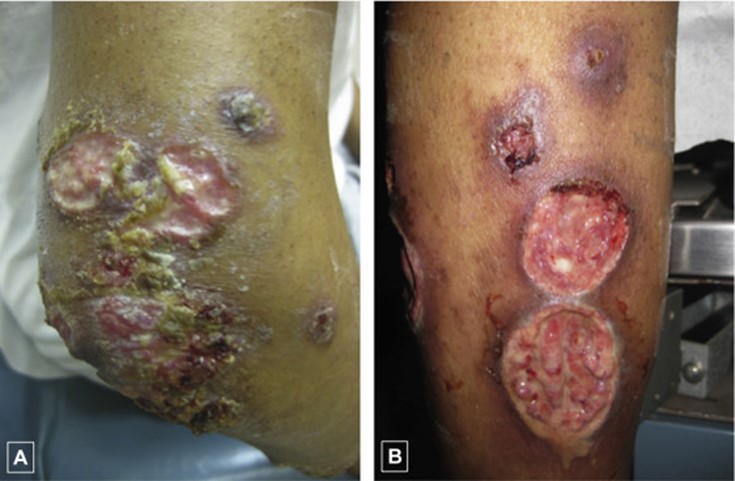 Images for DWII of malignant syphilis