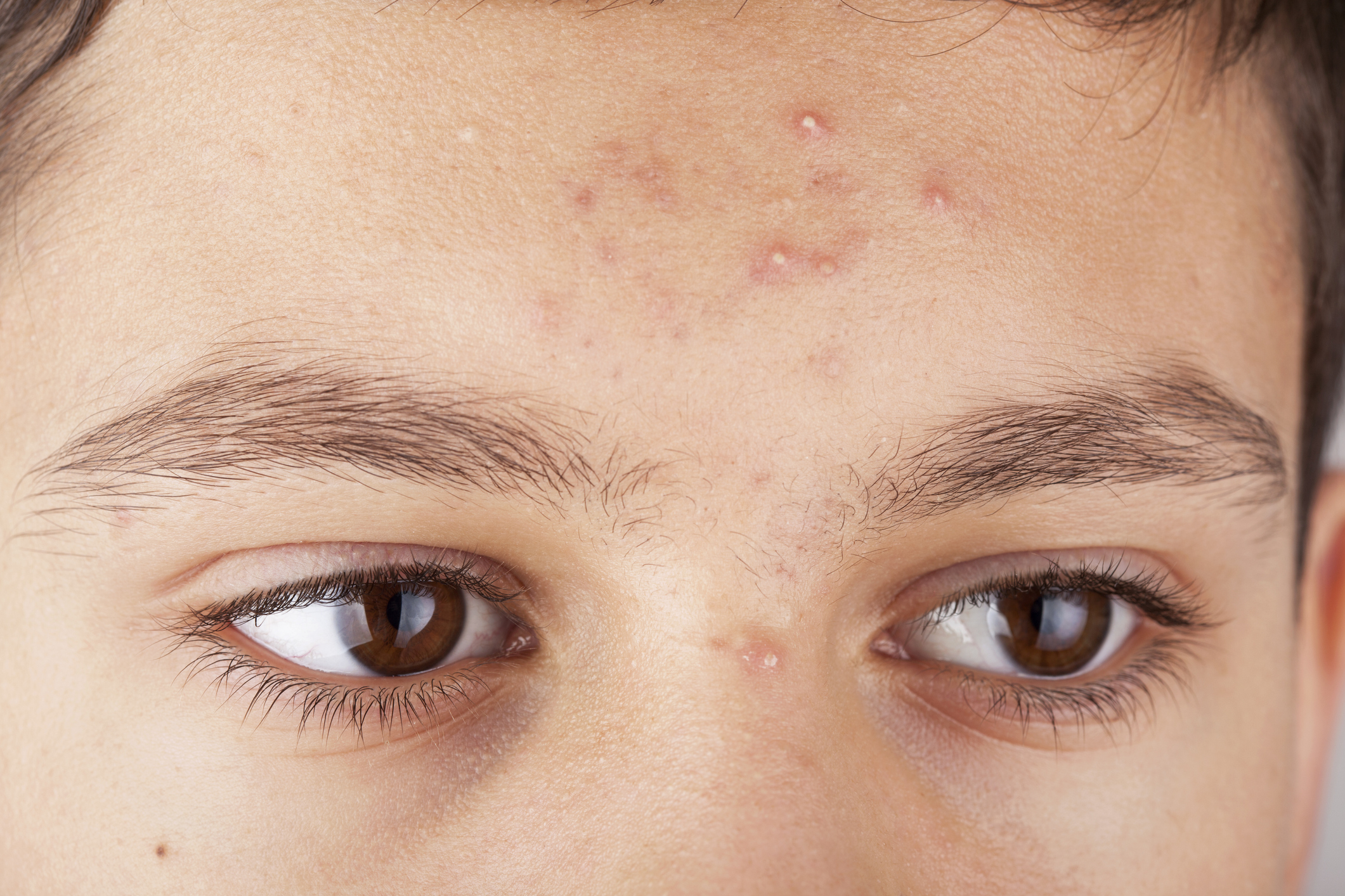 Acne: Signs and symptoms