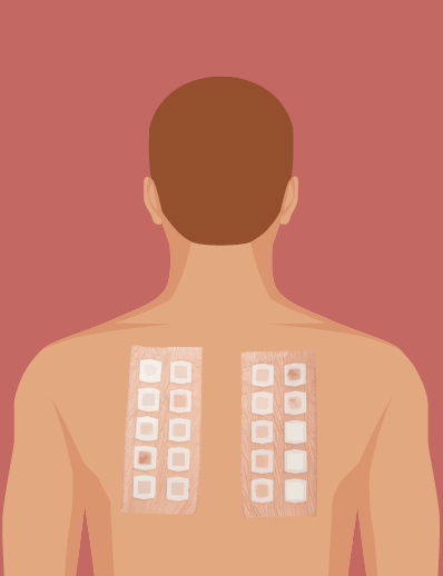 Dermatology World abstract illustration of allergy patch test