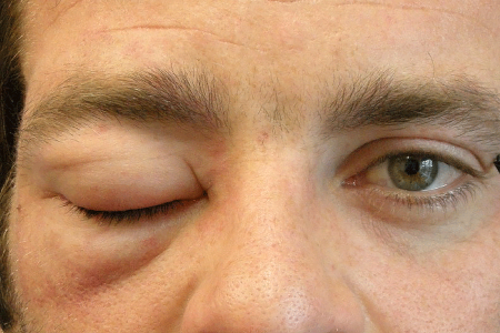 swelling (angioedema) on eyelid and skin beneath eyelid of man who has hives