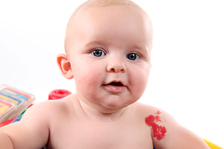 Baby with strawberry hemangioma birthmark