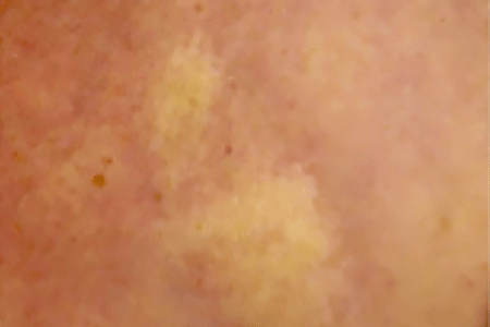 Close-up of scleroderma morphea patches on the skin
