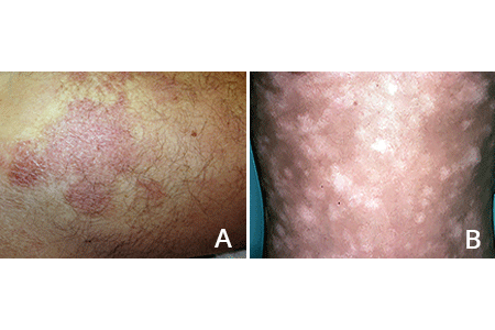 Two signs of mycosis fungoides are flat, scaly patches or light spot on the skin