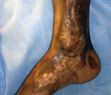 Linear morphea on lower leg and foot