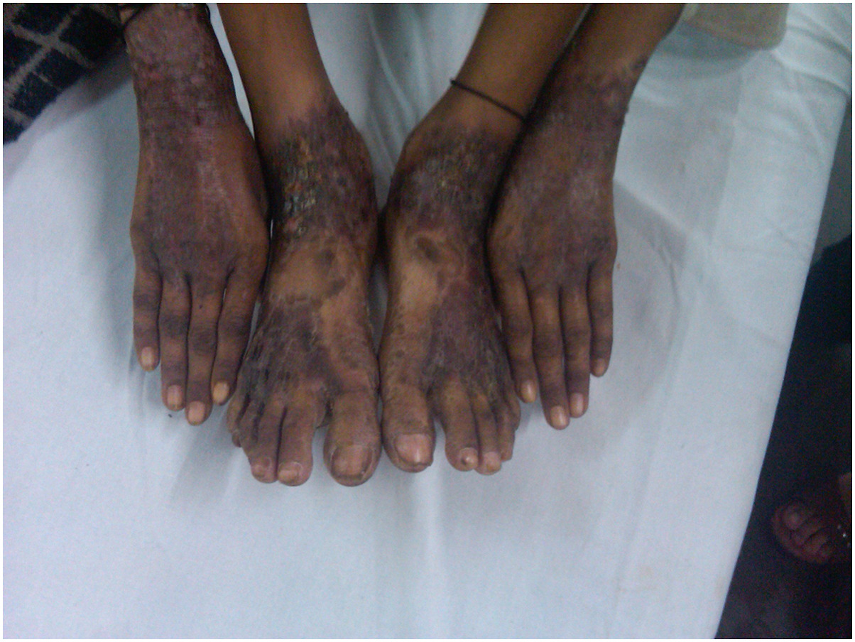 Image for DWII of a man's hands and feet showing the signs of pellagra