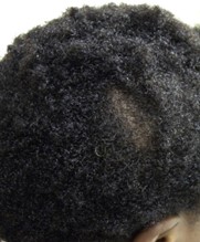 Patchy alopecia caused by several episodes of chemical straightening in the past. Image from JAAD 2015 Jan;72(1 Suppl):S39-40.