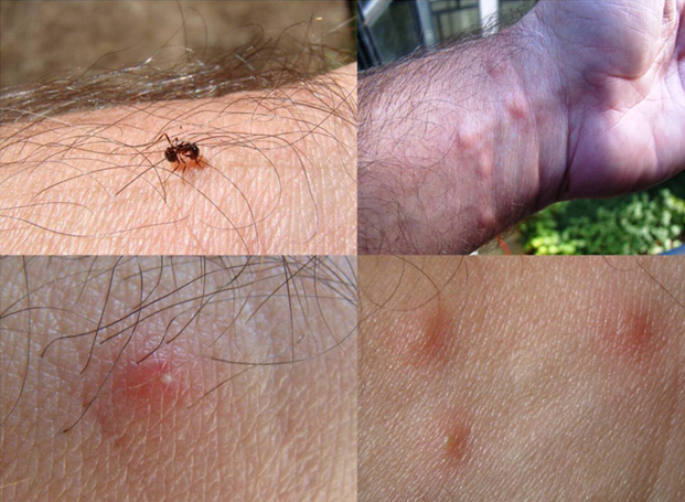 Skin reactions to fire ant venom
